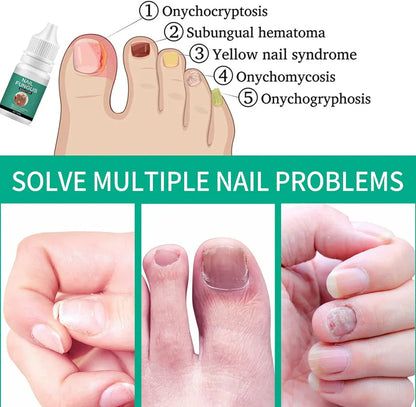 Nexusdrop Nail Treatement Solution